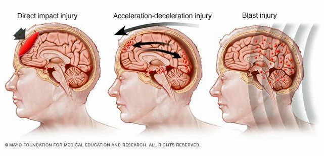 Common types of mechanisms which cause concussion