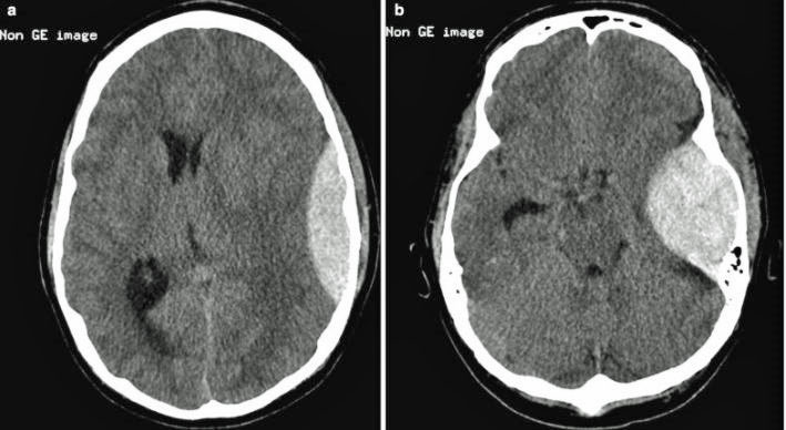 Epidural Hematoma as seen in more severe traumatic brain injury