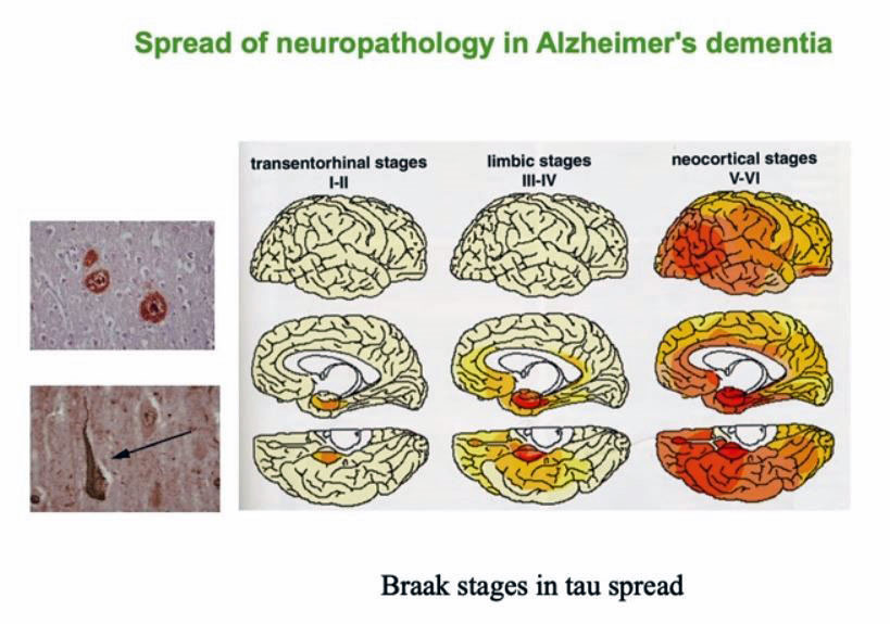 Figure 30: Stages of Alzheimer's dementia. Note the brain to the left has the pathology starting in the entorhinal /hippocampal area and then spreading through the brain