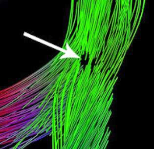 Damage to some selected nerve fibers (axons) as seen on MRI-DTI